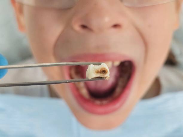Best Emergency Treatment for Toothache in Lucas, TX